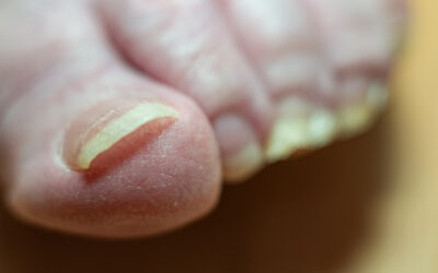 How to Get Rid of Toenail Fungus