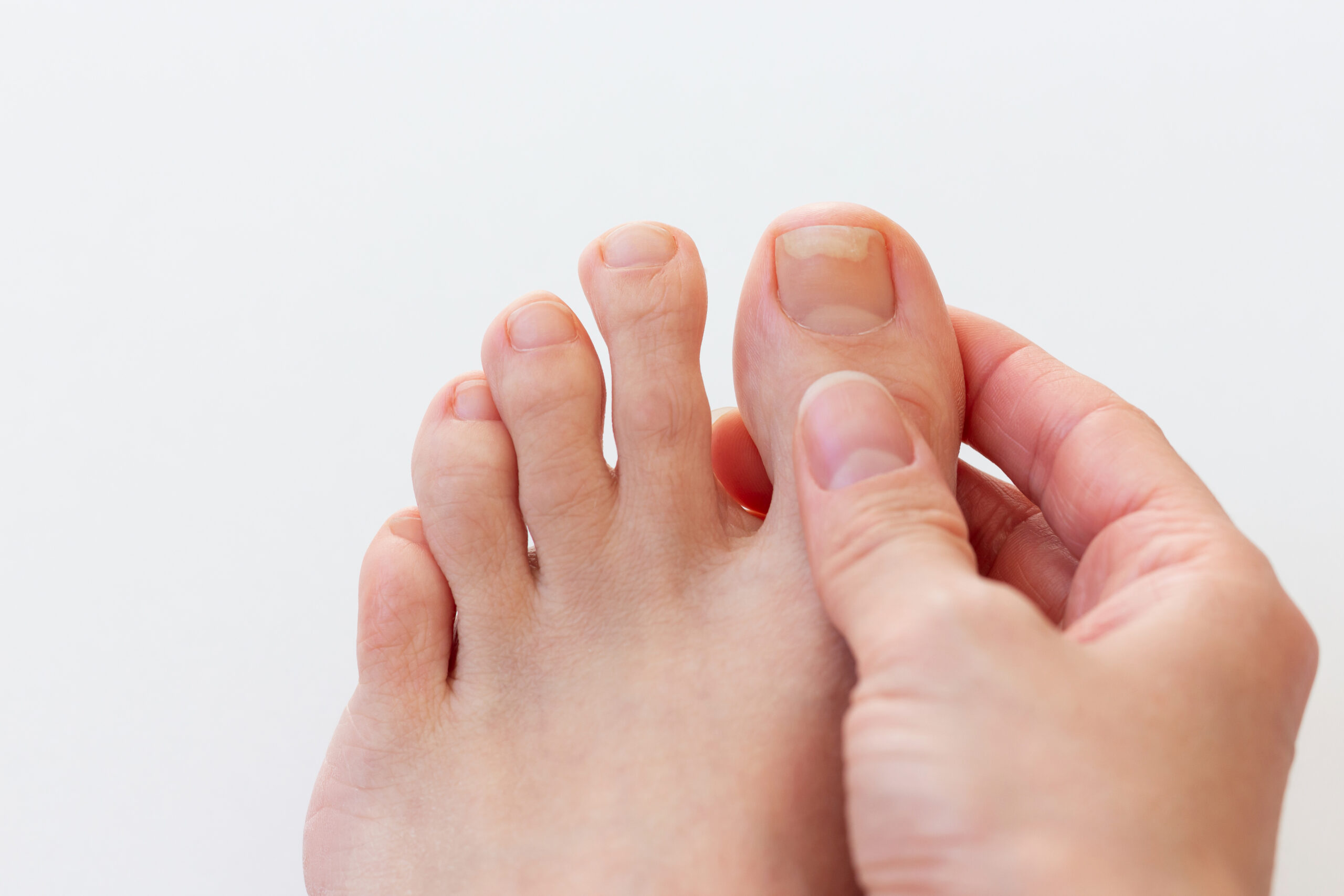 Close up of hand holding female foot with damaged toenail affected by fungus infection or onycholysis disease over white background.